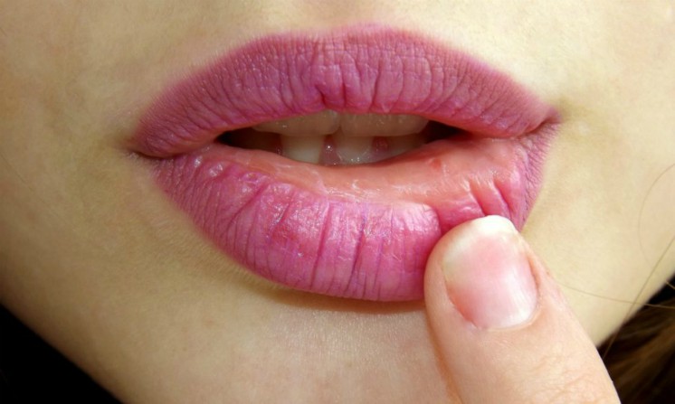 Labbra screpolate e secche