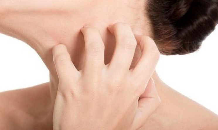 Psoriasi rimedi naturali